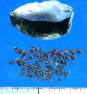 Stones Presentation Three types of stones are recognised Cholesterol stones (15%) Mixed stones (80%) Pigment stones