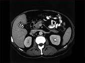 Gram-negative organisms are the most common isolated Acute cholecystitis Empyema of the gallbladder Mucocele of the