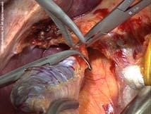 Management of Gallstones Operative Management Remember >80% take them to the grave Dissolution