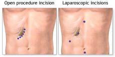 Laparoscopic Cholecystectomy (cholecystotomy) Open Cholecystectomy Mini Cholecystectomy Op