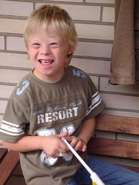 Down Syndrome (DS) Prevalence: 1 in 800 Caused by an extra copy of the 21 st chromosome Most