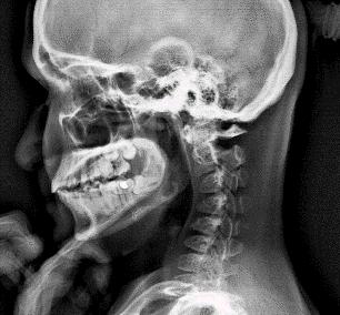 What is considered a Cervical Deformity?