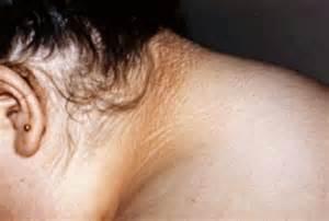 acanthosis nigricans (uh-kan-tho-sis NIH-grih-kans) a skin condition characterized by darkened skin patches; common in people whose body is not responding