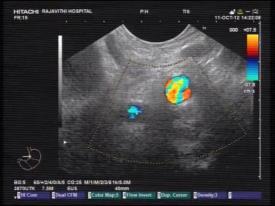 bilateral endoscopic ultrasound-guided celiac plexus block or
