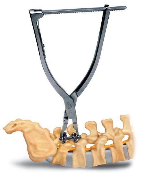 NUT LOCKING ADDITIONAL SURGICAL OPTIONS For nut locking, there are two ways of proceeding: Use the X-ray markers