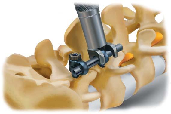 When using the spondylolisthesis screws, breakage of the excess thread can be made with the spondylolisthesis tube wrench (ref. 2270-44) and extracted with the Hex 20 Nut guide (ref. 2270-48).