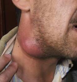 lymphadenitis 43 yo male with cervical LN swelling x 4 wks. No fever, cough.