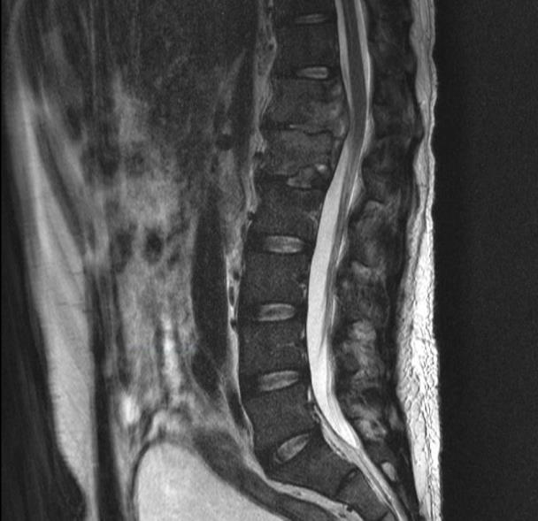 spinal tuberculosis Diskitis, osteomyelitis +/- paraspinous
