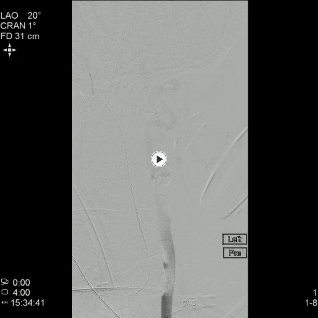 Fig. 2: Thrombectomy performed on a 65 year old male with left