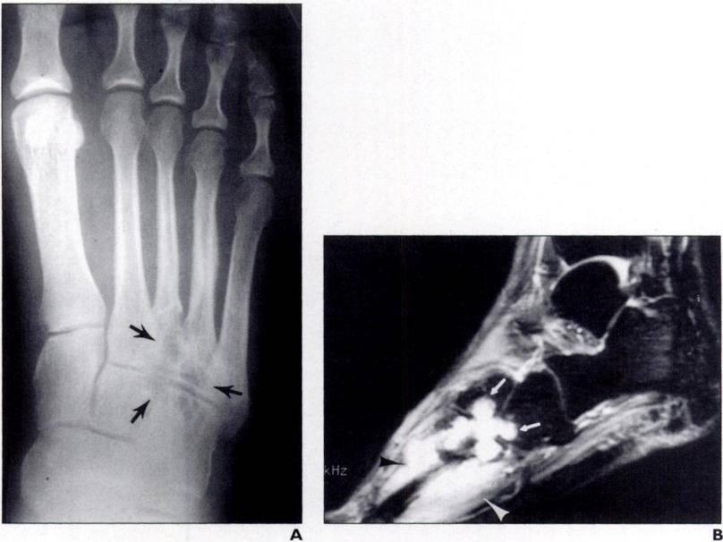 Lin et al. Fig. 1-31-year-old woman with giant celltumor oftendon sheath in left foot.