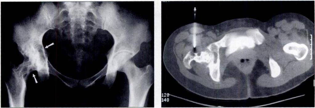 .- Pigmented Villonodular Synovitis Fig. 3.-26-year-old woman with advanced pigmented villonodular synovitis of right hip.