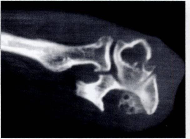 1 i#{149} t Fig. 5.-48-year-old woman with pigmented villonodular synovitis of elbow.