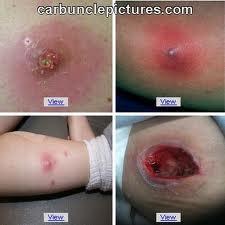 Cellulitis It is an acute diffuse suppurative inflammation caused by streptococci, which secrete hyaluronidase & streptokinase enzymes that dissolve the ground