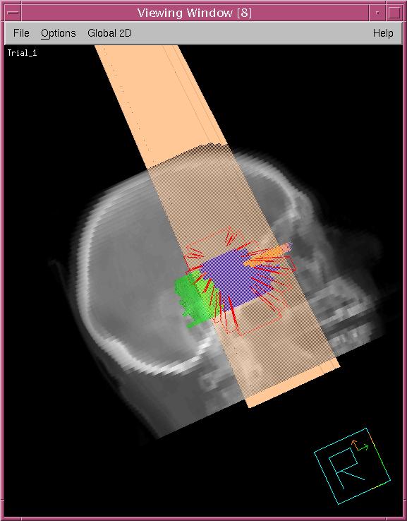 Non-coplanar beams (peach and red) aimed at a brain tumor(purple), displayed on a digitally reconstructed