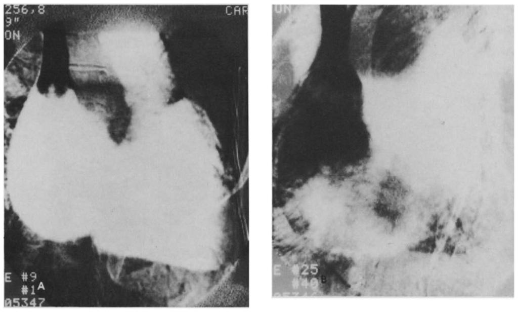 secondary to the left to right shunt at atrial level. (Reprinted from Yiannikas J, et al. [5] with permission.) Figure 2.