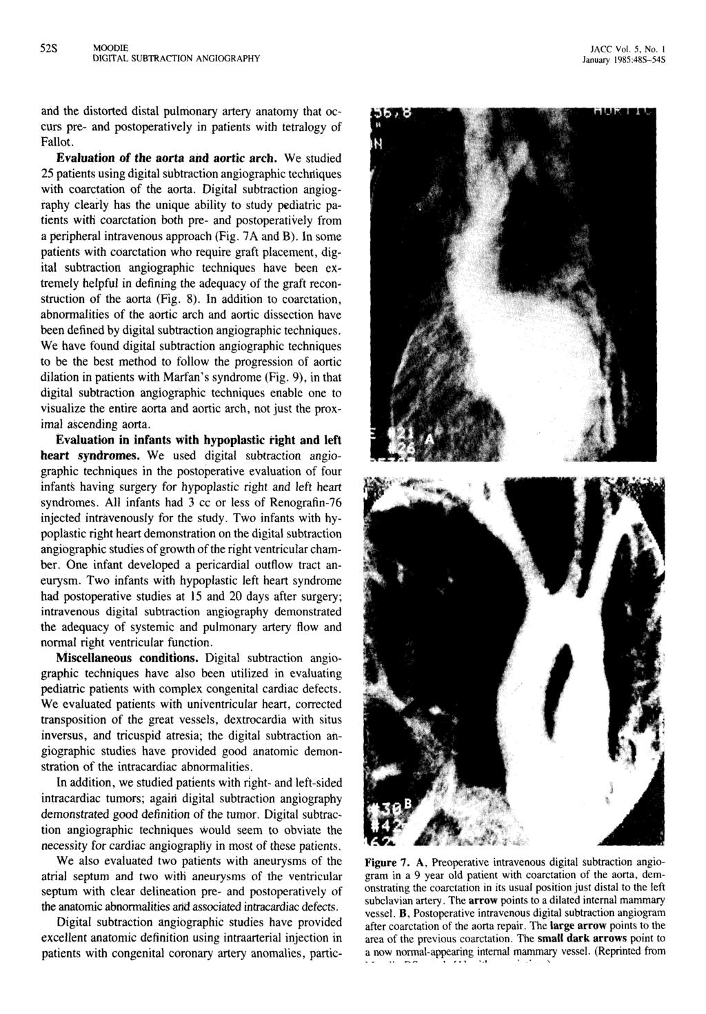 52S JACe Vol. 5. No.1 January 1985:485-545 and the distorted distal pulmonary artery anatomy that occurs pre- and postoperatively in patients with tetralogy of Fallot.
