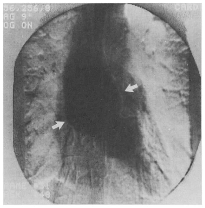 aneurysm. Arrows point to the dilated ascending aorta. Figure 10.