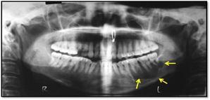Intraoral examination revealed a firm swelling in the left pterygomandibular region (Figure 7) with no pus discharge. It was nontender on palpation and overlying mucosa was normal. There Figure 7.