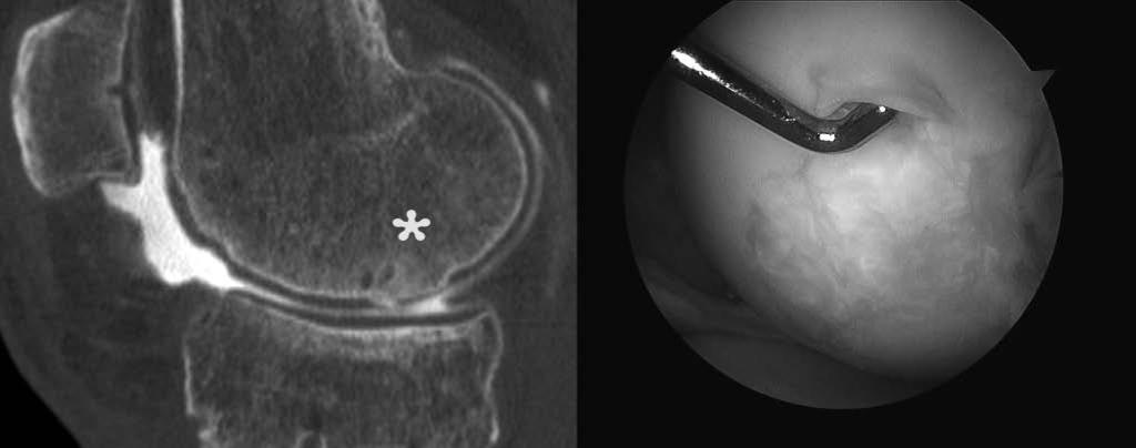 906 Minas et al The American Journal of Sports Medicine Figure 1. Left, preoperative CT arthrogram depicting a previously microfractured chondral defect on the medial femoral condyle.