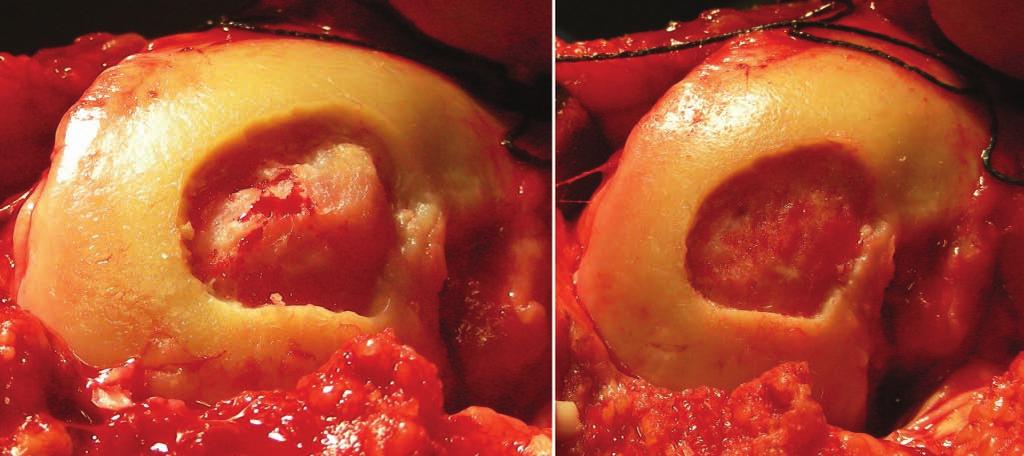 Modes of failure after marrow stimulation. Left, delamination; center, intralesional osteophyte; right, subchondral cyst. to worse results.