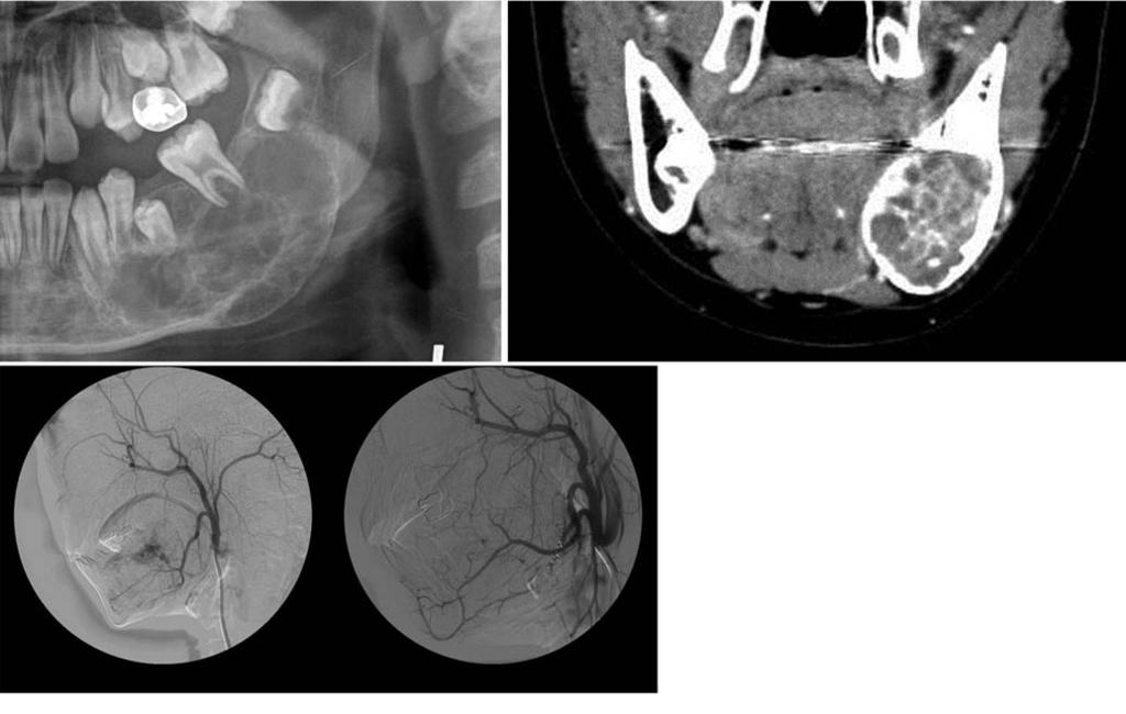 . Coronal contrast enhanced CT scan shows an expansile, multilocular osteolytic lesion with multiple internal septation and multiple fluid levels within cystic spaces at the left mandible. C. The bloodpool (left) and delayed phase (right) reveal an increased radiotracer uptake in the left mandibular body area.