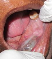 5 cm below lower border of mandible, superiorly at the level of commissure of mouth with normal overlying skin in color without any sinus and drainage and there was no local rise in temperature.