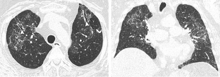 Chronic hypersensitivity pneumonitis: differentiation from UIP and NSIP using thin-section CT Silva C.