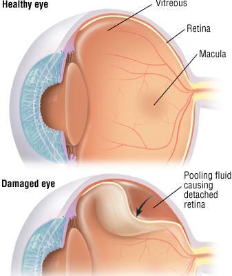 What is Retinal Detachment (RD)? Retina is the light-sensitive layer at the back of the eye that converts light images into nerve impulses that are relayed to the brain to produce sight.