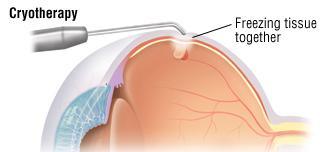 Can we prevent RD? Prevention: Most retinal detachments are age related, and there is no way to prevent them.