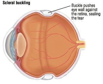 Scleral buckling A silicon band is placed on the outside of the eyeball. A tiny hole is made in the sclera (the tough layer beneath the retina, also known as the white of the eye).