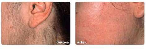Hair Removal Ellipse long-term hair removal: Humans have had a problem with hair for thousands of years.