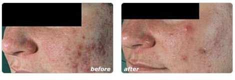 Acne Clearance Acne: Most of us experience acne to some extent during our lives. For many people it is a short-term annoyance, but others develop more long-term and more severe acne.
