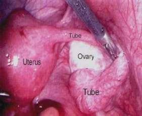 The two fallopian tubes, which are about 10 to 13 centimeters long, extend from the