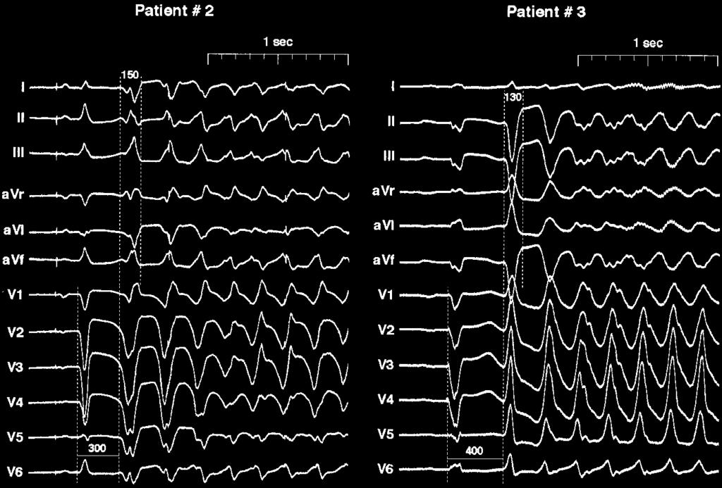 Bänsch et al Catheter Ablation of VF After MI 3013 Figure 1. Twelve-lead surface ECGs of VPBs initiating ventricular tachyarrhythmias. Left, ECG of patient 2.