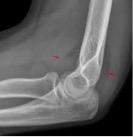 Consider a radial head injury in any of the following: Disruption of the usual smooth continuous concave shape of the radial head (may be very subtle or not visible on initial x-rays) Anterior sail