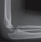 if the patient is unable to extend the elbow enough. Consider separate x-ray views of the humerus and forearm to better assess the integrity of the bones of the elbow.