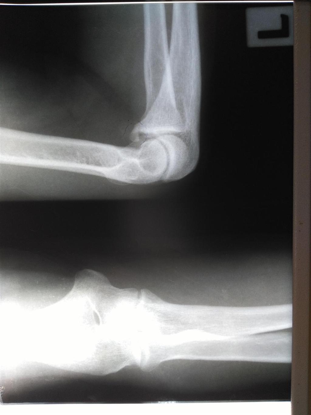 ORIF, and may be a sign of elbow subluxation or dislocation. They occur with FOOSH and elbow hyperextension, and present with pain over the antecubital fossa.