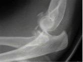 It is imperative to look carefully for coronoid fractures on x-ray for all elbow injured patients as these tiny fractures may indicate an unstable joint. Pitfall #4.