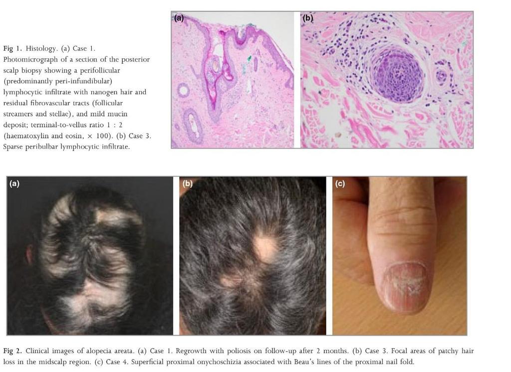 Alopecia areata induced by immune