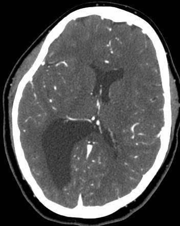 CT brain Stable ex vacuo dilatation of the temporal
