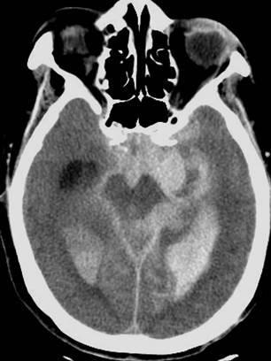CT brain Extensive subarachnoid hemorrhage in the basal cisterns, fissures, and