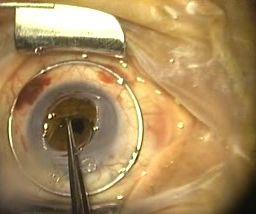 COMPLICATIONS Intraocular lens implantation after vitreous loss in lost ability of residual posterior