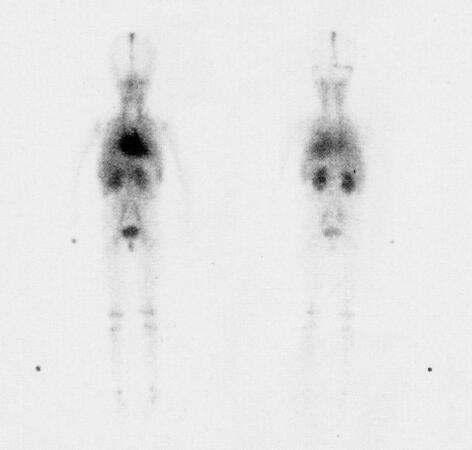 Blood Pool Images 6: Age 3 4 Years A double headed whole body gamma camera was used Left image is the anterior view Right image is the posterior view