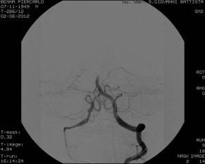 The most serious Hyperdense MCA T occlusion of carotid Basilar