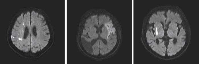 2) Neuroimaging Plasma Brain Natriuretic Peptide as a Predictive Marker of Early Recurrent Stroke in Cardioembolic Stroke Patients