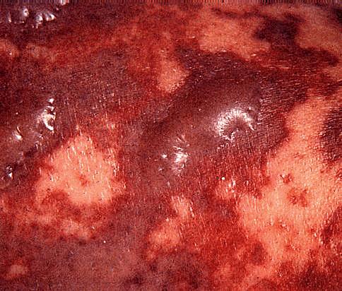 Skin Lesions of Meningococcemia NOTE:
