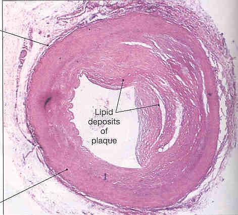 Atherosclerosis Marked narrowing of the arterial lumen due to