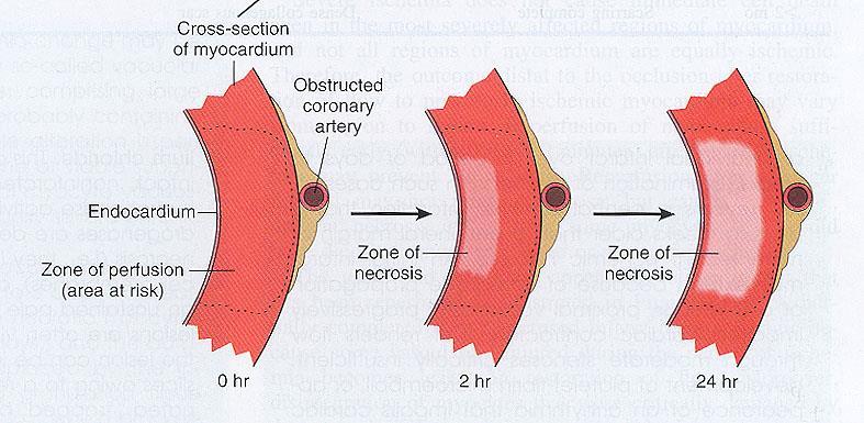 Infarct extension Diagram from
