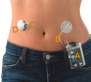 Insulin infusion pumps Enables normal basal insulin to be markedly reduced or suspended whist performing exercise.