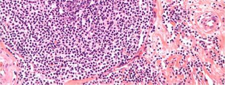 diffuse large B cell CD3 lymphoma